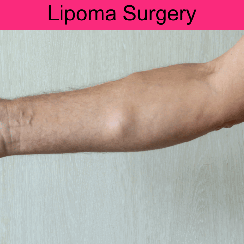 Cost for Lipoma removal