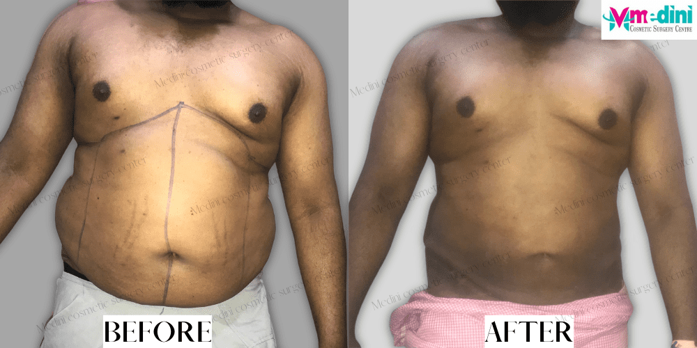 stomach fat removal surgery before and after