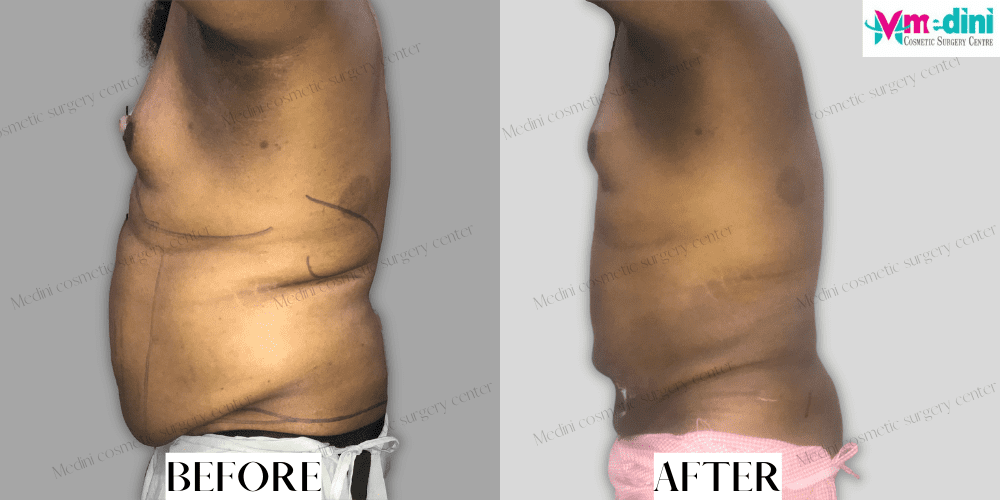 stomach fat removal surgery before and after
