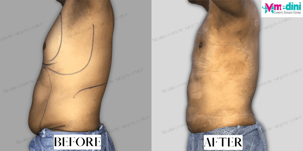 Fat Removal Surgery Stomach before and after
