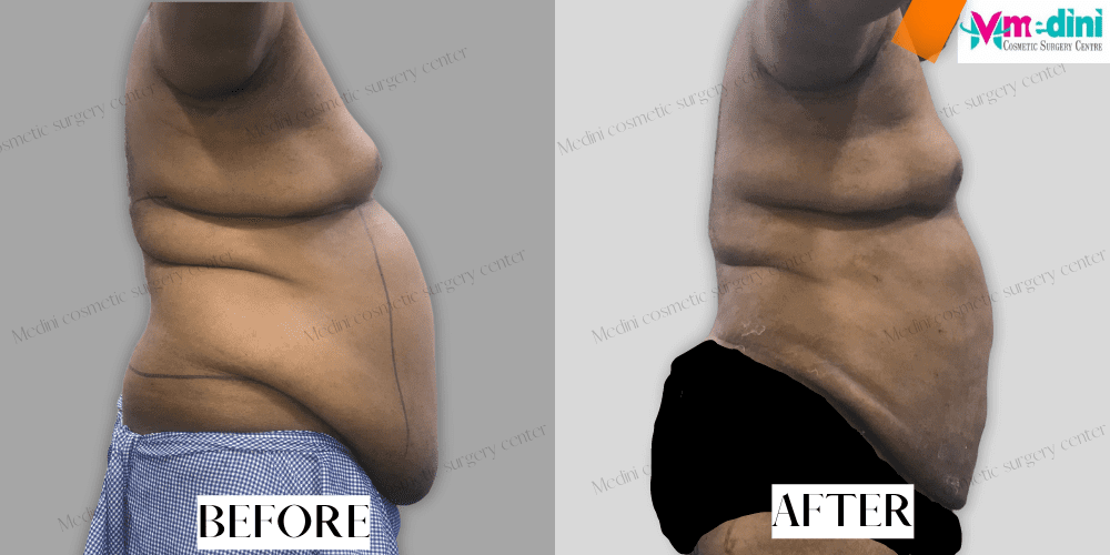 Stomach liposuction before and after