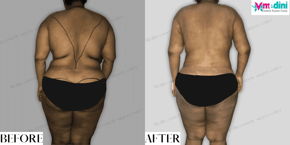 Back liposuction before and after