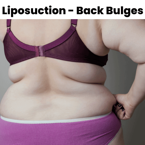 Bra bulges - Liposuction