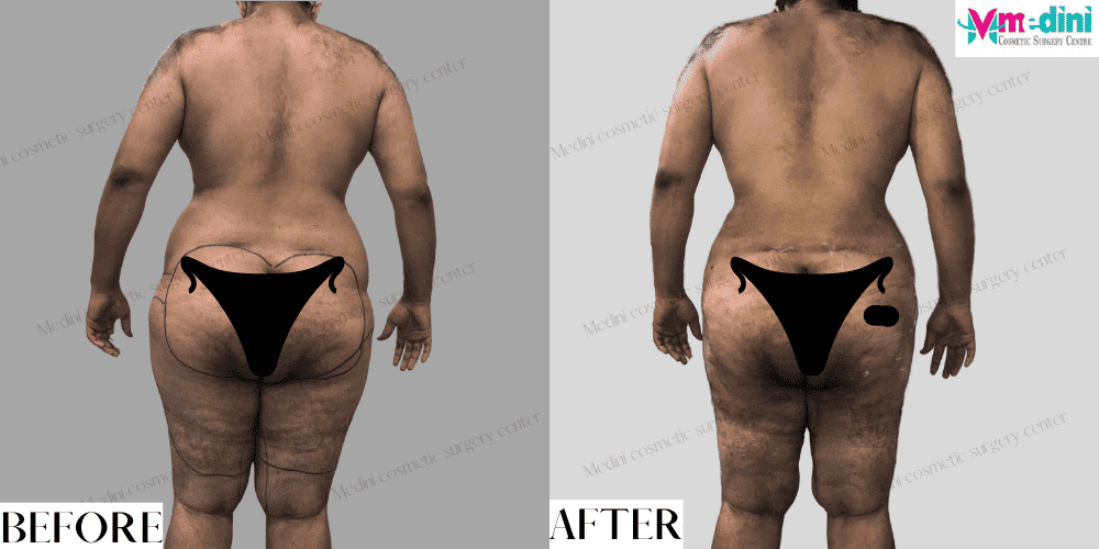 Liposuction Abdomen Thighs Before After