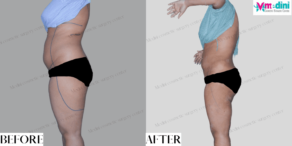 Liposuction before and after India Abdomen Thighs photos