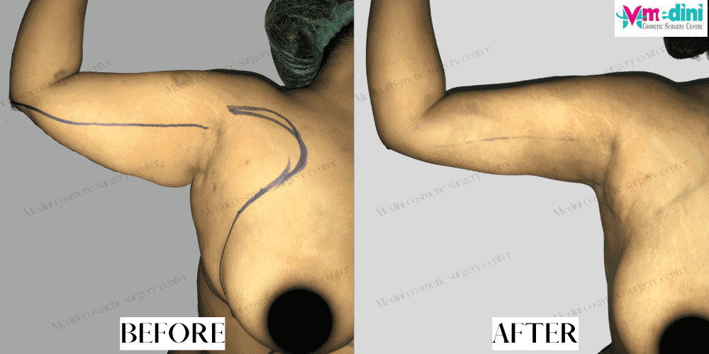 Arm liposuction before after