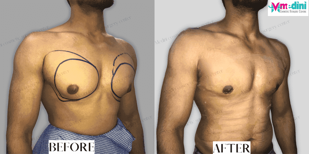 bodybuilder gynecomastia before and after