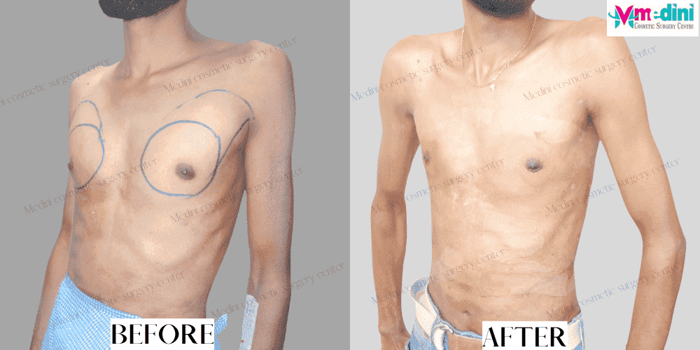 gynecomastia before after