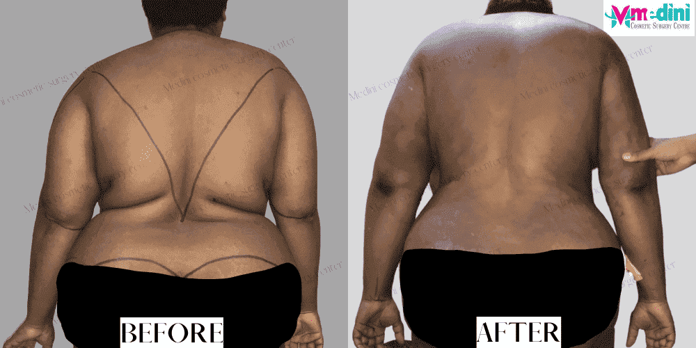 stomach fat removal surgery before after