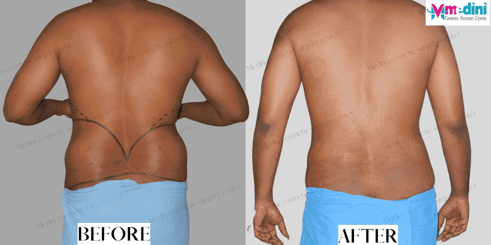 patient 4 : liposuction of Abdomen, Lovehandles,Back