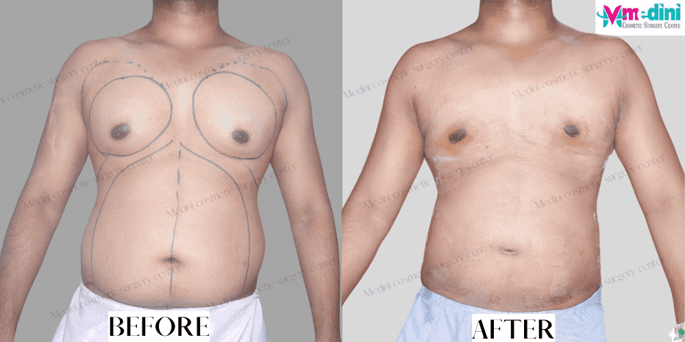 Men liposuction before after abdomen chest photos