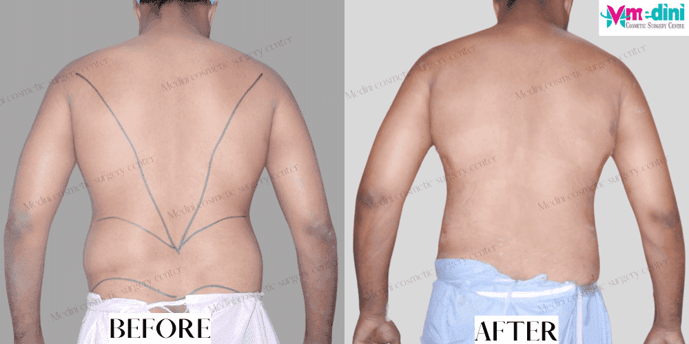 Men liposuction before after abdomen chest photos