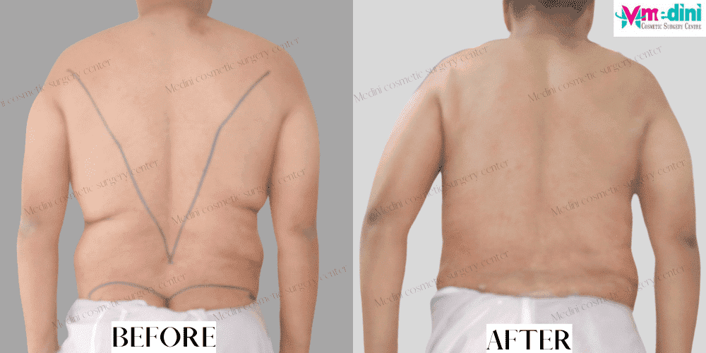 men liposuction before and after