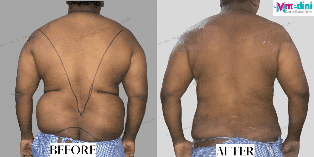 men liposuction before and after