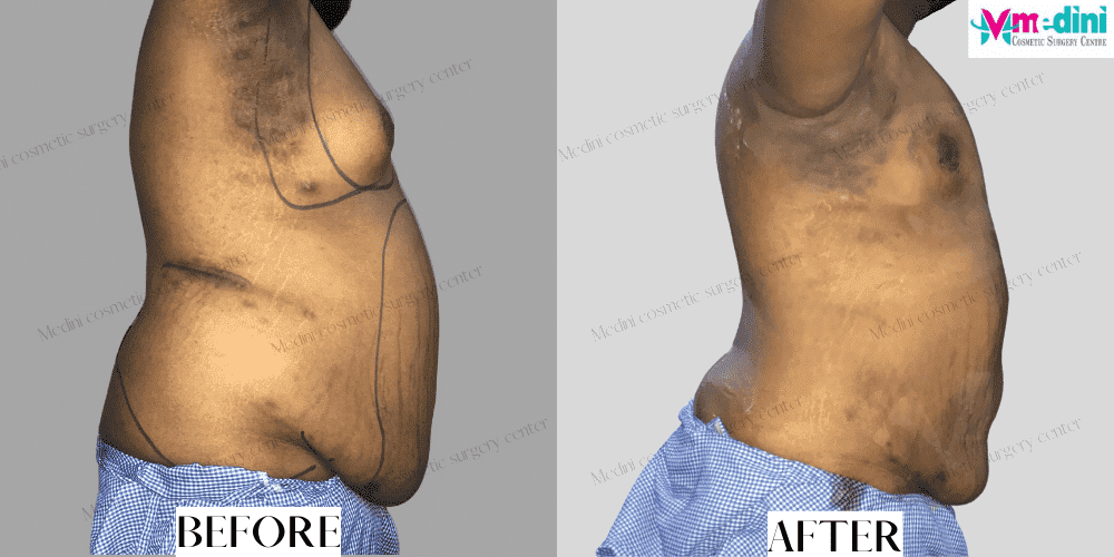 Men liposuction before after chest abdomen