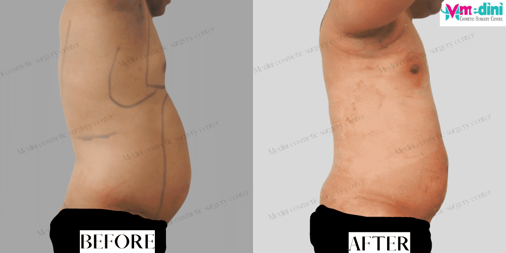 men liposuction before after chest abdomen