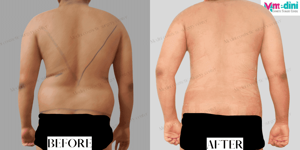 men liposuction before after chest abdomen