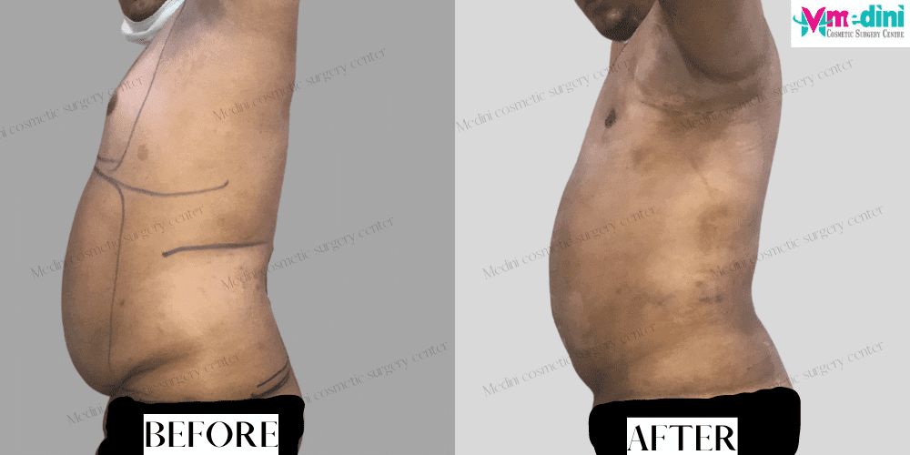 male liposuction before after abdomen chest images