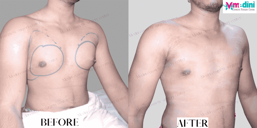 Gynecomastia grade1 before and after