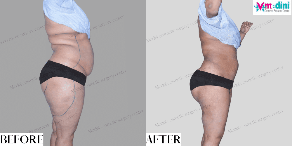 Liposuction before after India abdomen thighs