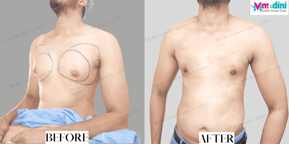 grade 1 gynecomastia before and after