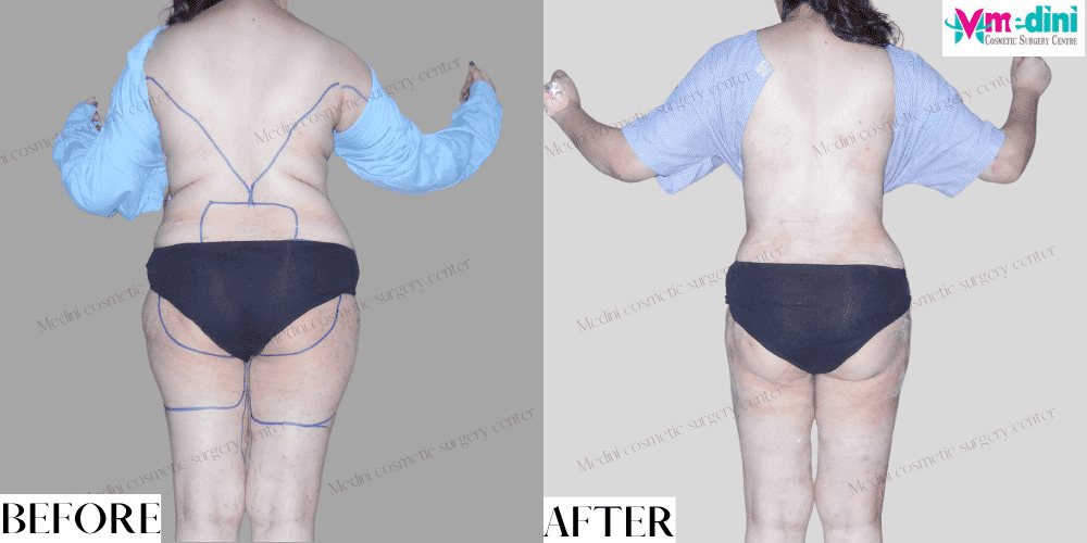 fat removal surgery abdomen, thighs before after
