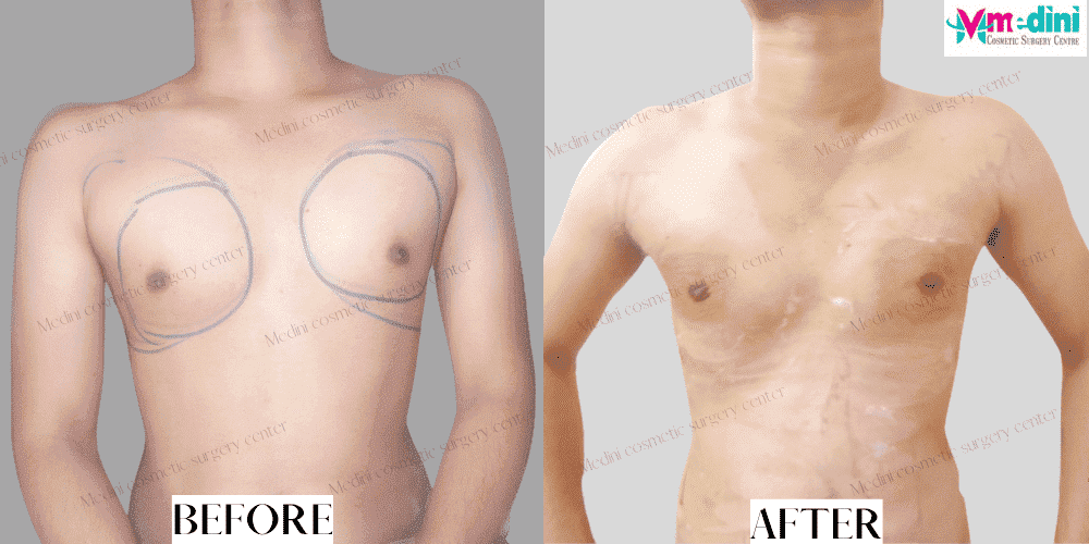 gynecomastia surgery before and after
