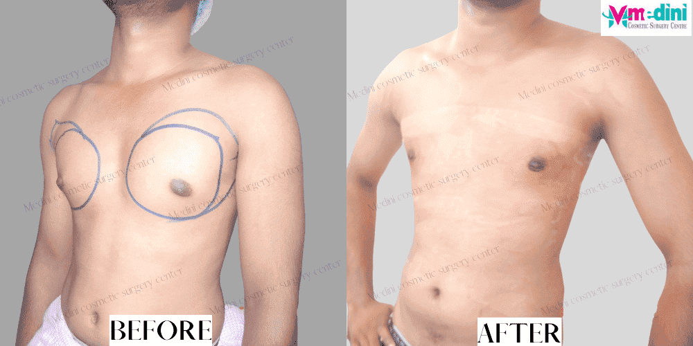 gynecomastia surgery before after