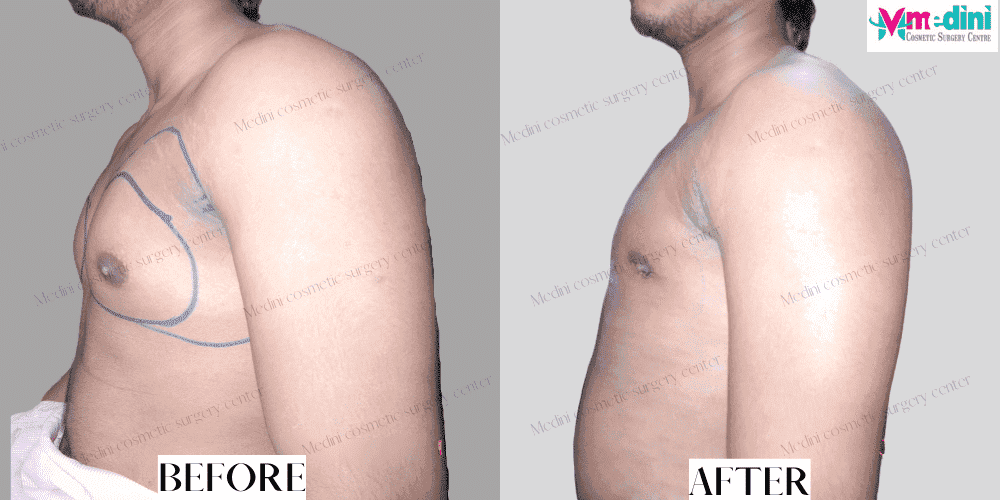 Gynecomastia grade1 before and after