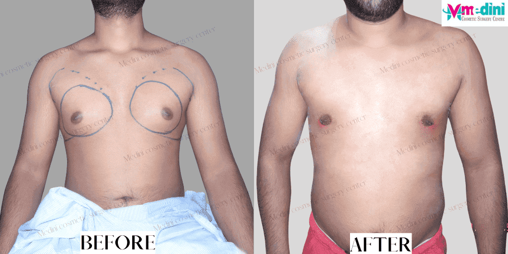Grade 2 Gynecomastia before and after