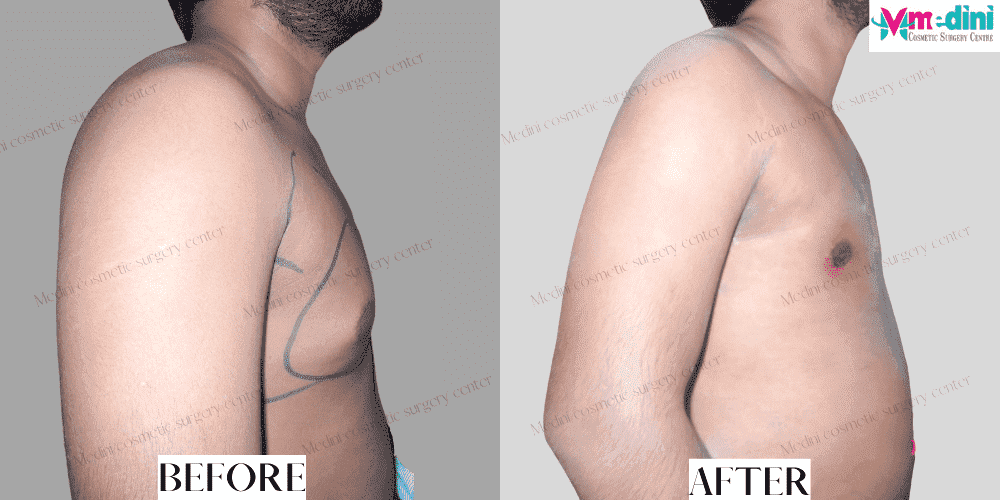 Grade 2 Gynecomastia before and after