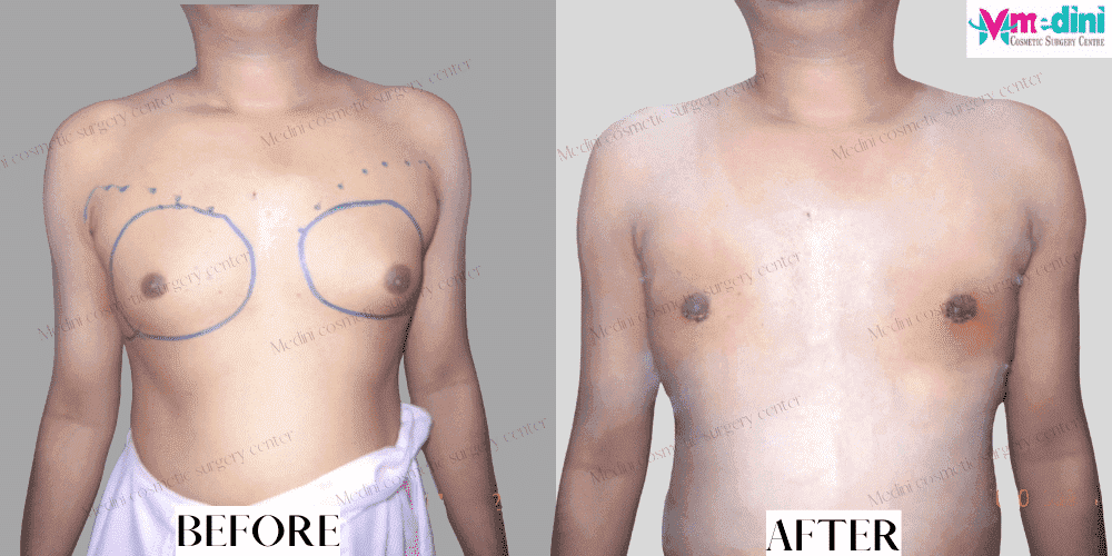 Gynecomastia grade 2 before and after photos