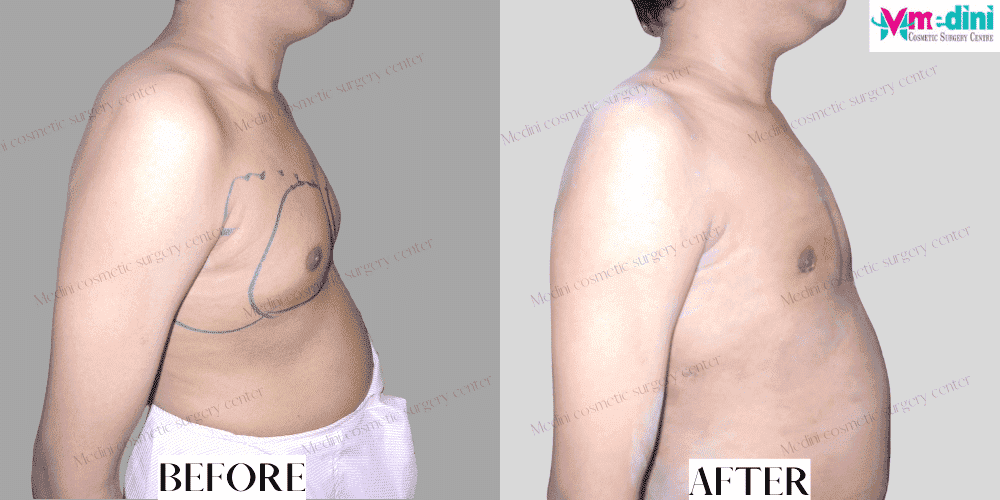 Gynecomastia grade 2 before and after photos