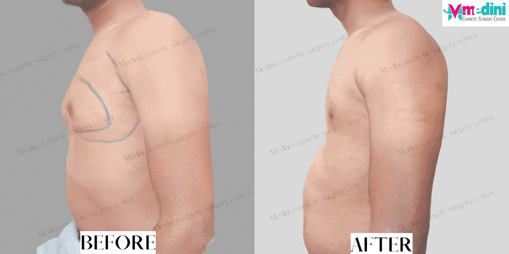 Grade 2 gynecomastia before and after