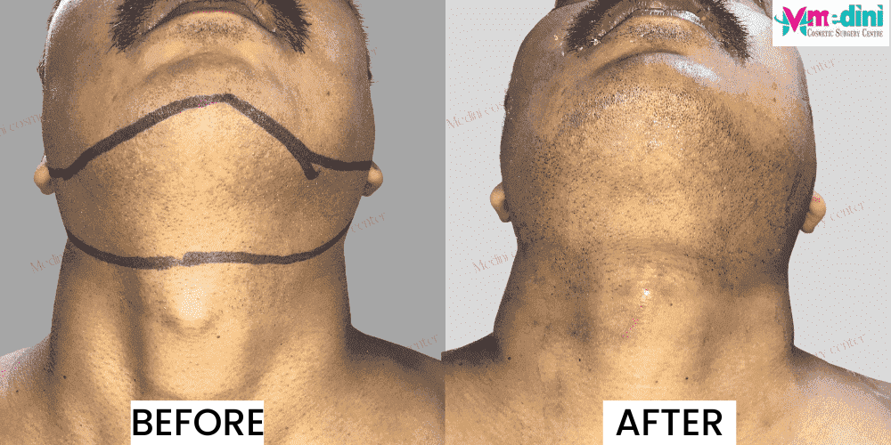 male liposuction before and after double chin