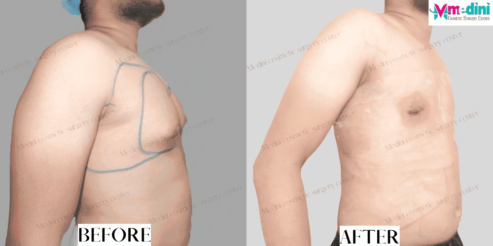 Grade 2 gynecomastia before and after