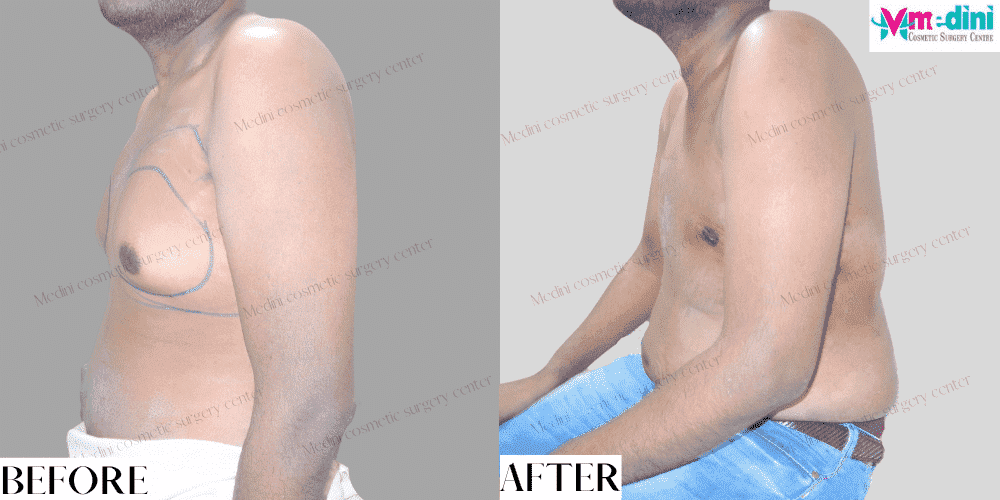 Grade 3 gynecomastia before and after