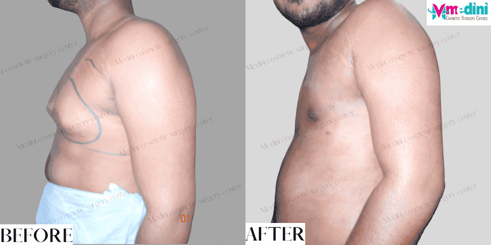 Grade 3 gynecomastia before and after