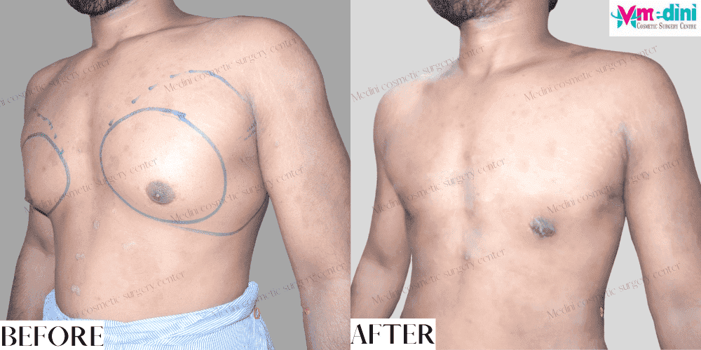 Gynecomastia grade 3 before and after