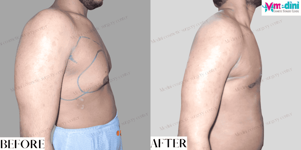 Gynecomastia grade 3 before and after