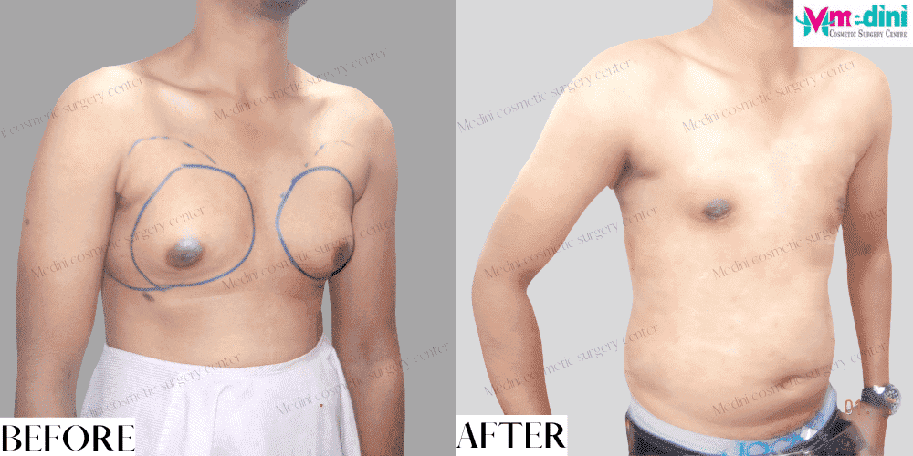 Gynecomastia Grade 3 Before and After