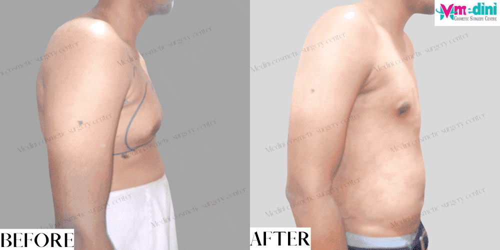 Gynecomastia Grade 3 Before and After