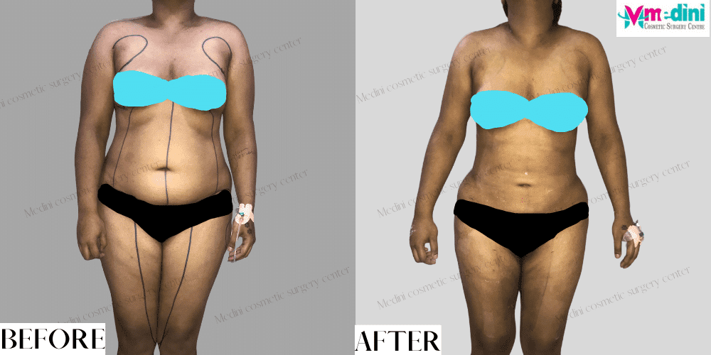 liposuction before and after India abdomen and thighs images