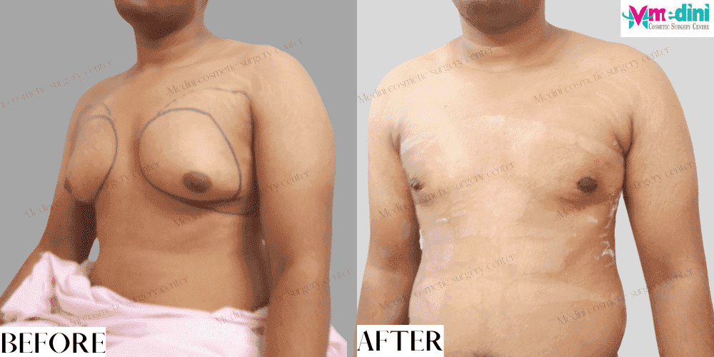Gynecomastia surgery before and after