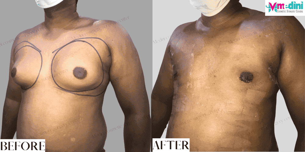 Gynecomastia surgery before and after