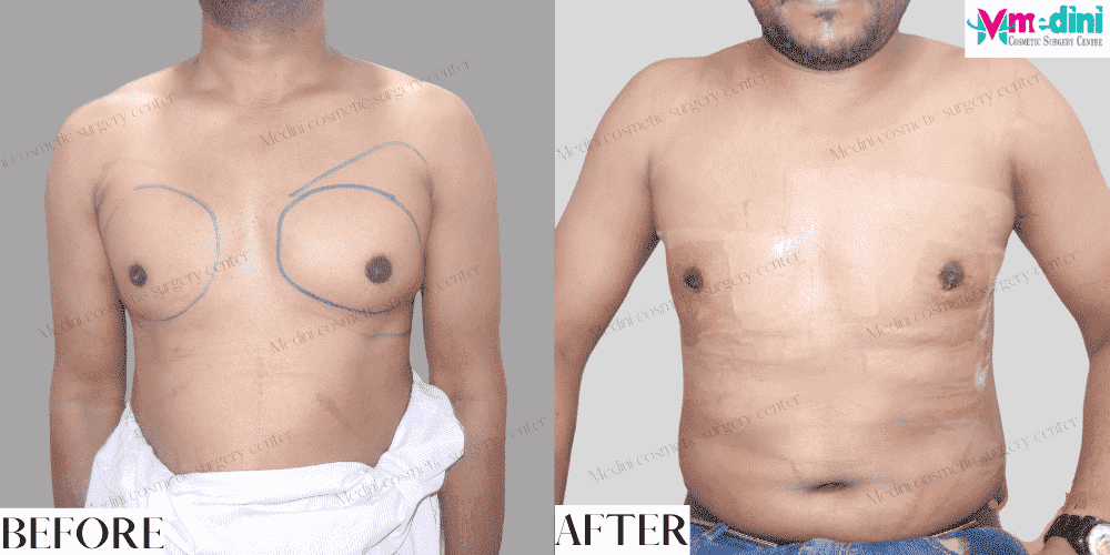unequal gynecomastia before and after