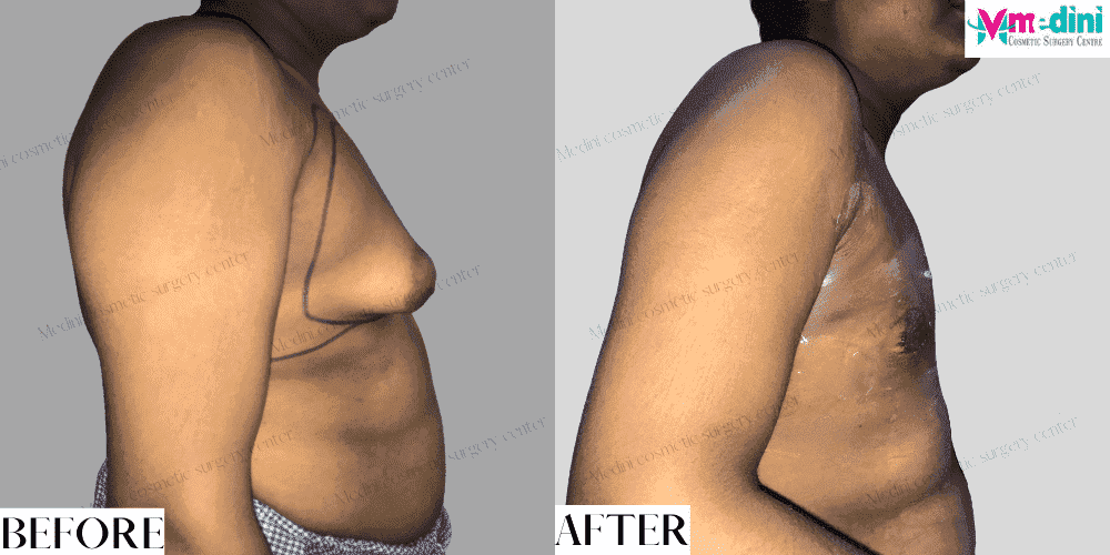 unilateral gynecomastia surgery before after