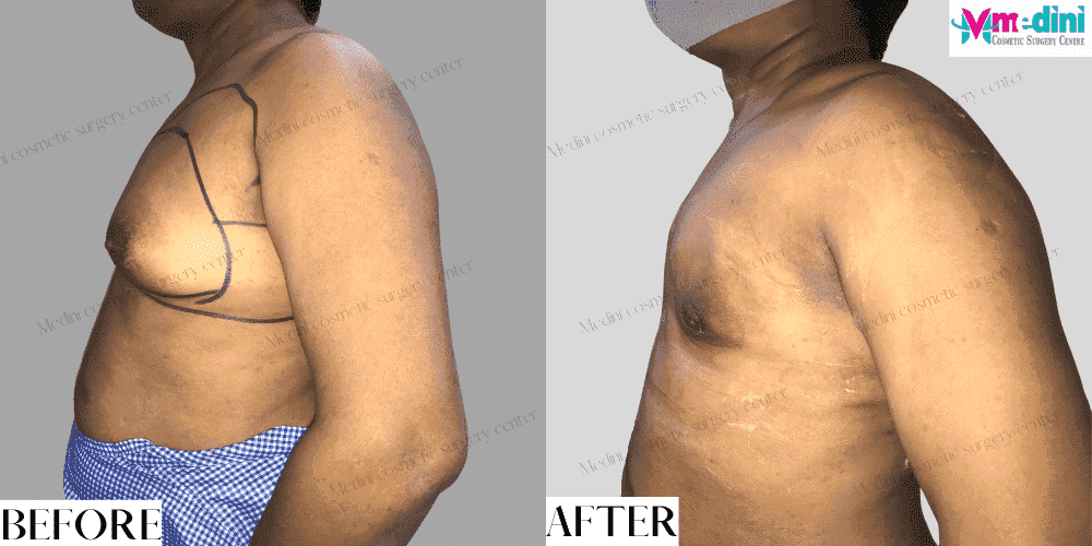 unilateral gynecomastia before and after