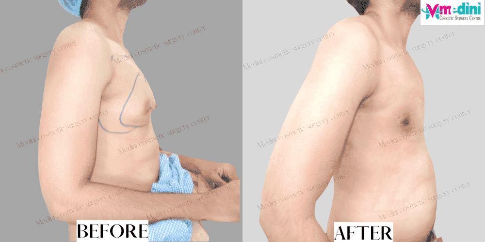 grade 1 gynecomastia before and after