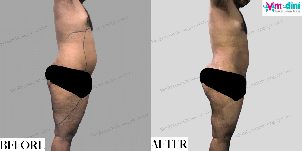 Liposuction Abdomen Thighs Before After